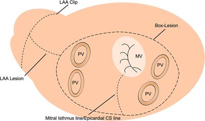 Left atrial strain predicts the rhythm outcome in patients with persistent atrial fibrillation undergoing left atrial cryoablation during minimally invasive mitral valve repair